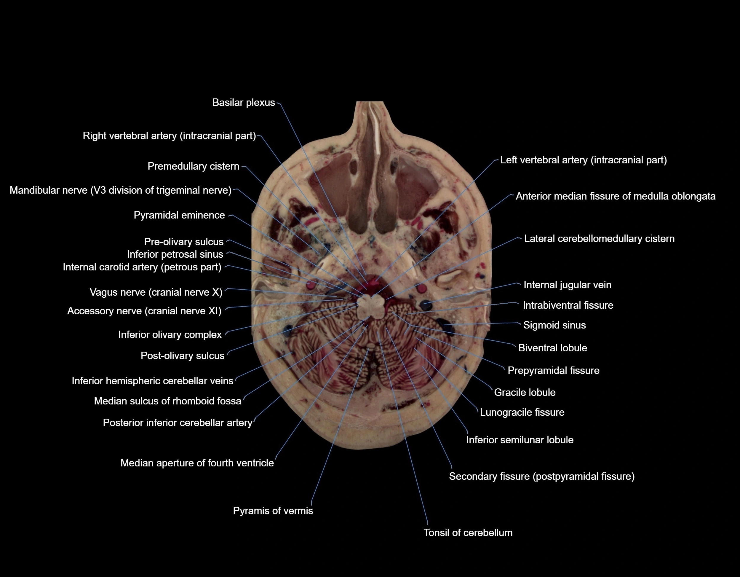 MRI Brain axial cross sectional radiology anatomy 3T image  -img-000011.webp